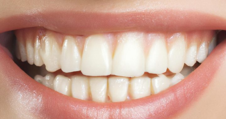 Top Causes of Tooth Erosion: How to Protect Your Smile