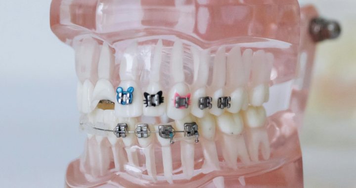 Top Dental Care Tips for Braces: Keep Your Smile Healthy and Bright