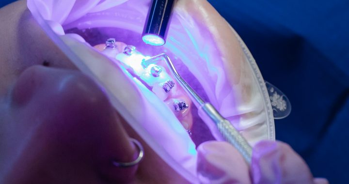 Essential Tips for Maintaining and Caring for Your Dental Implants